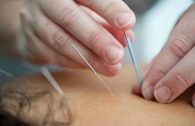 Le choix d’un bon acupuncteur